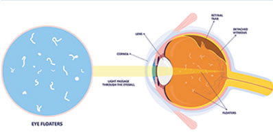 Contact Lens Fittings and Training