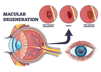 Contact Lens Fittings and Training