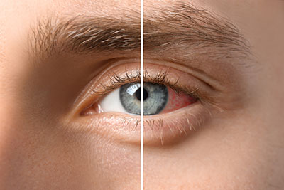 Contact Lens Fittings and Training